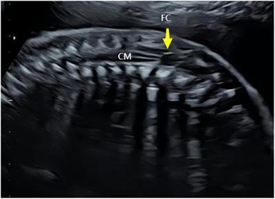 Prenatal ultrasound diagnosis and prognosis of fetus with isolated filar cyst: a retrospective analysis